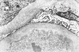 F,31y. | initial glomerular hyalinosis and sclerosis F,31y. | initial glomerular hyalinosis and sclerosis